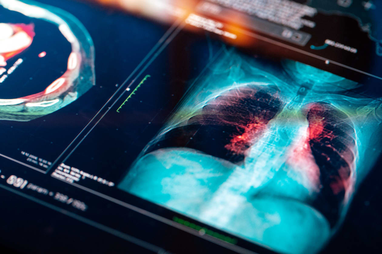 An experimental lung-cancer drug could replace Keytruda one day. But investors aren't wowed.