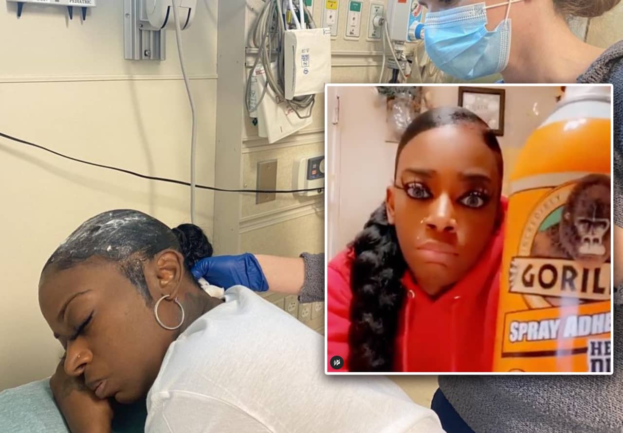 Gorilla Glue Girl' who accidentally stuck her hair to her head ends up in  hospital