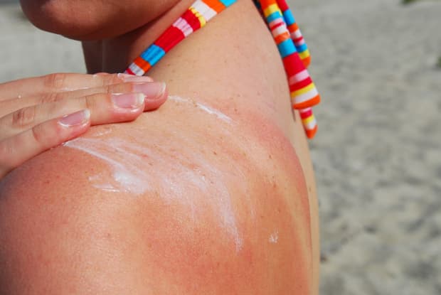 Аллергия на солнце в тайланде фото 5 best products to soothe sunburn, starting at $7, according to dermatologists a