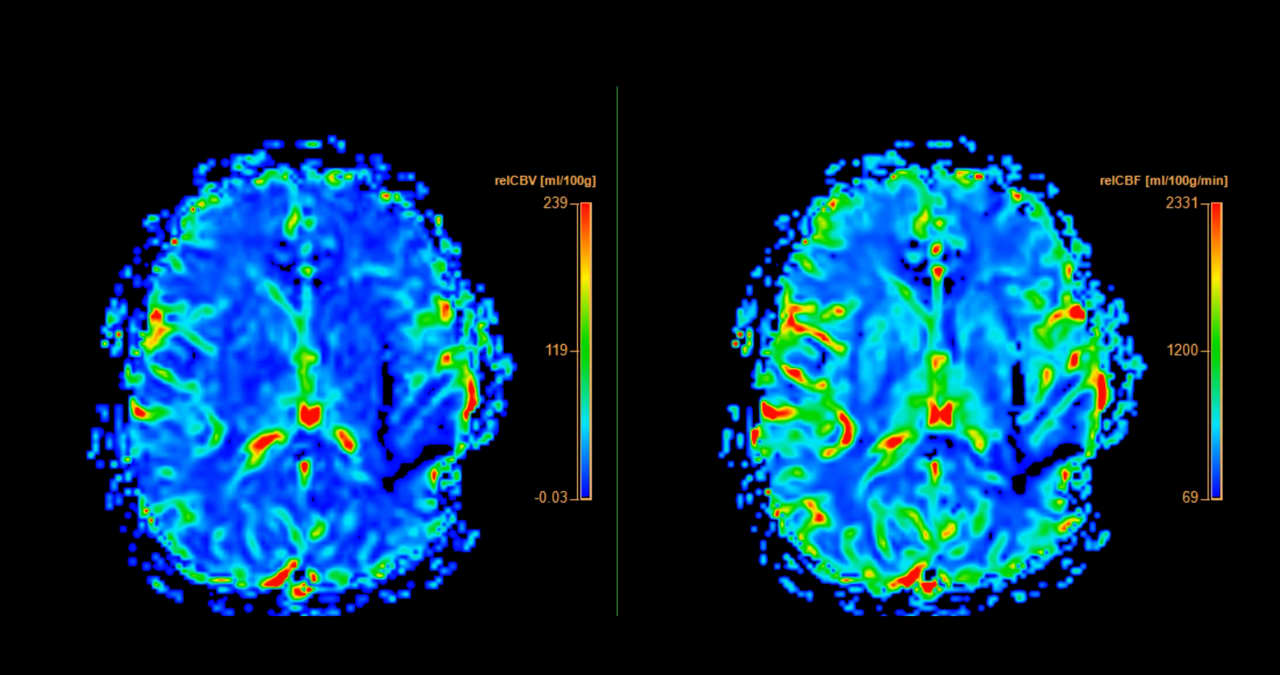 There’s still hope GLP-1 drugs could slow the second-biggest type of dementia