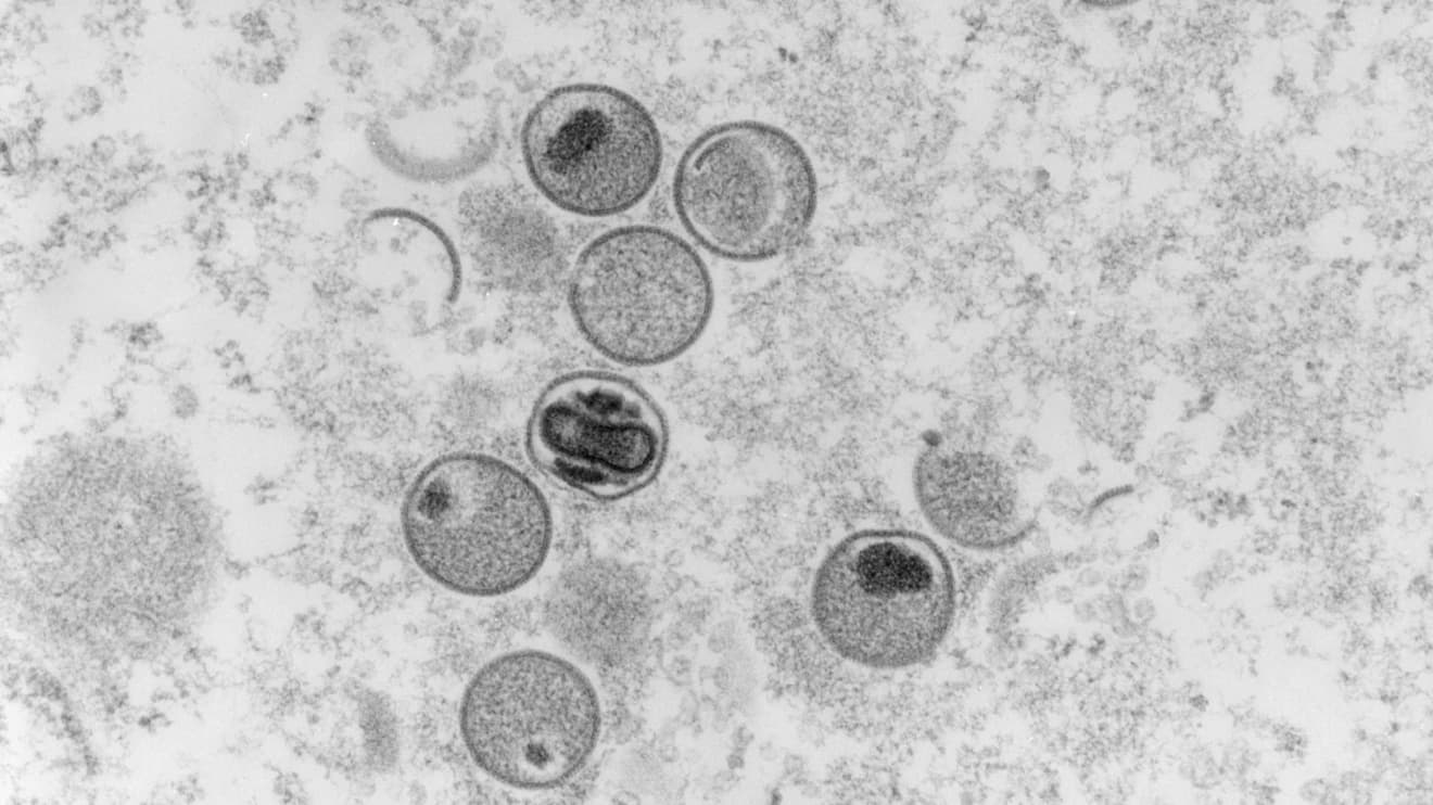 #The Margin: Monkeypox symptoms and how to tell if you have it: what you need to know