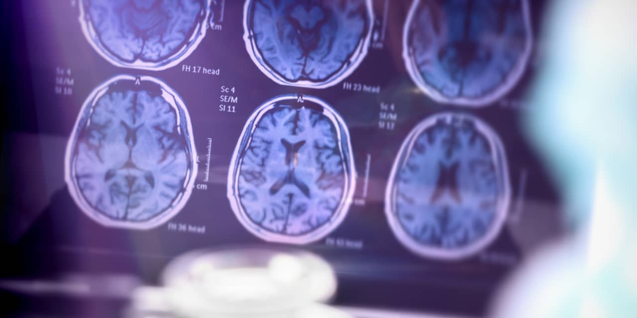 What to know about the Alzheimer’s drug data coming out this week