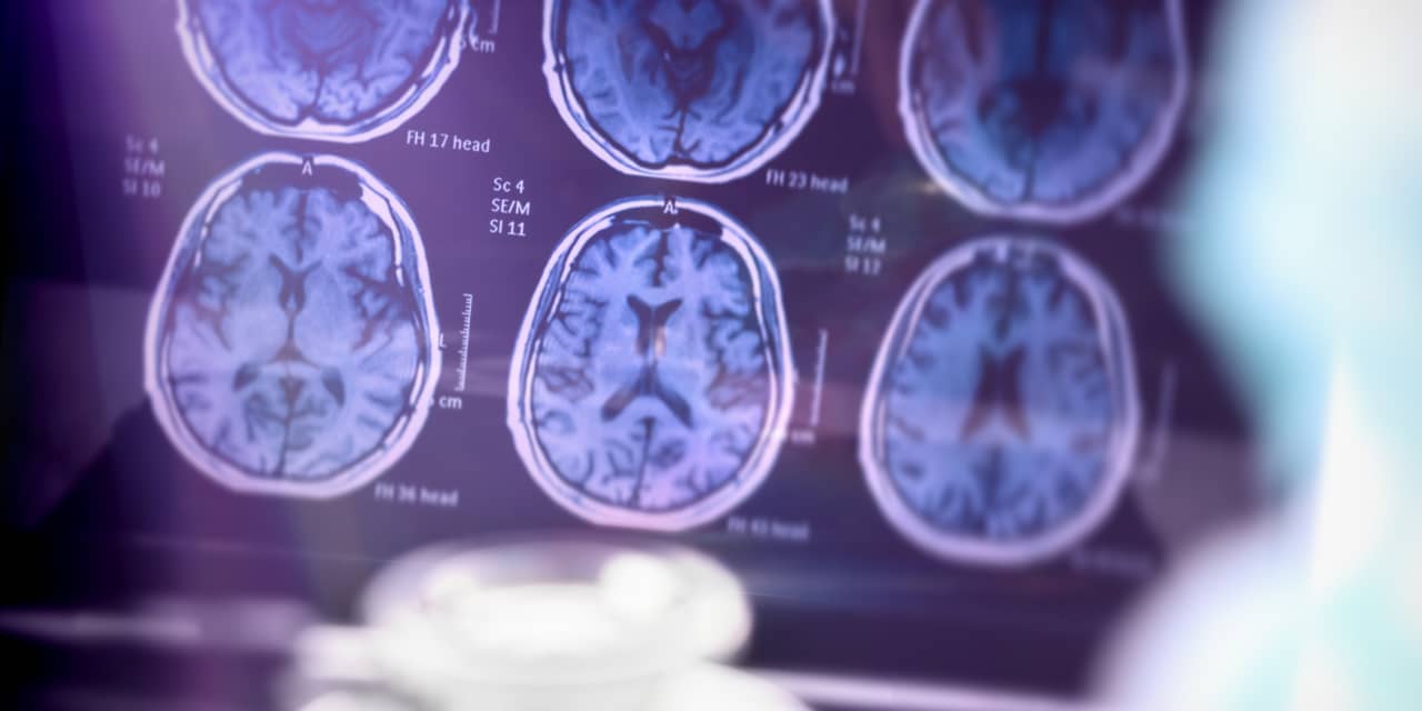 #: What to know about the Alzheimer’s drug data coming out this week